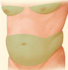 Liposuction-01 Liposuction